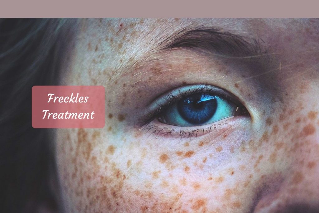 freckles treatment