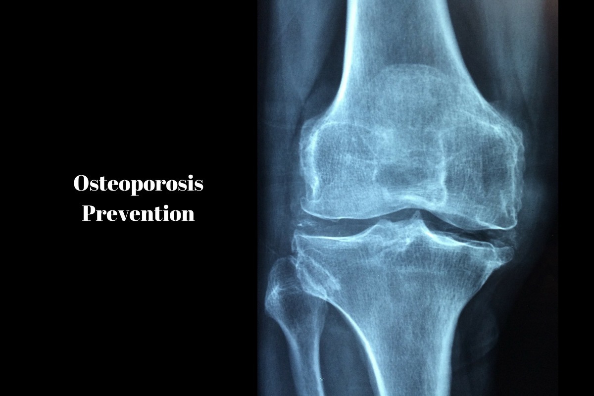 Osteoporosis Prevention: Lifestyle Tips And Home Remedies