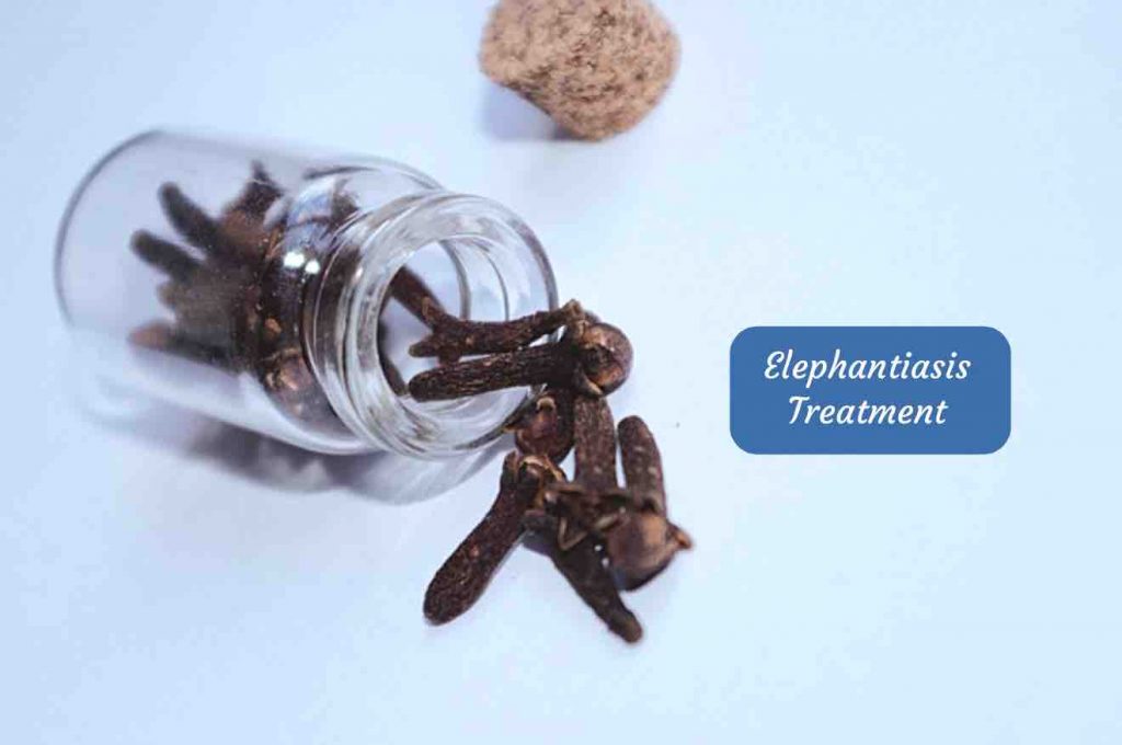 Elephantiasis Treatment