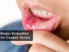 How to get rid of canker sores _ Ayurvedum