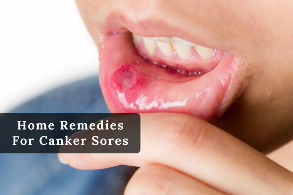 How to get rid of canker sores _ Ayurvedum