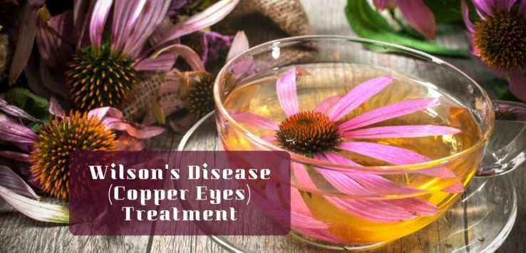 wilson's disease treatment _ Ayurvedum