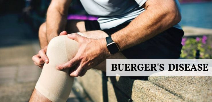 Buerger's disease _ Ayurvedum