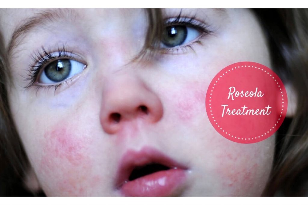 Roseola Rash Treatment _ Ayurvedum