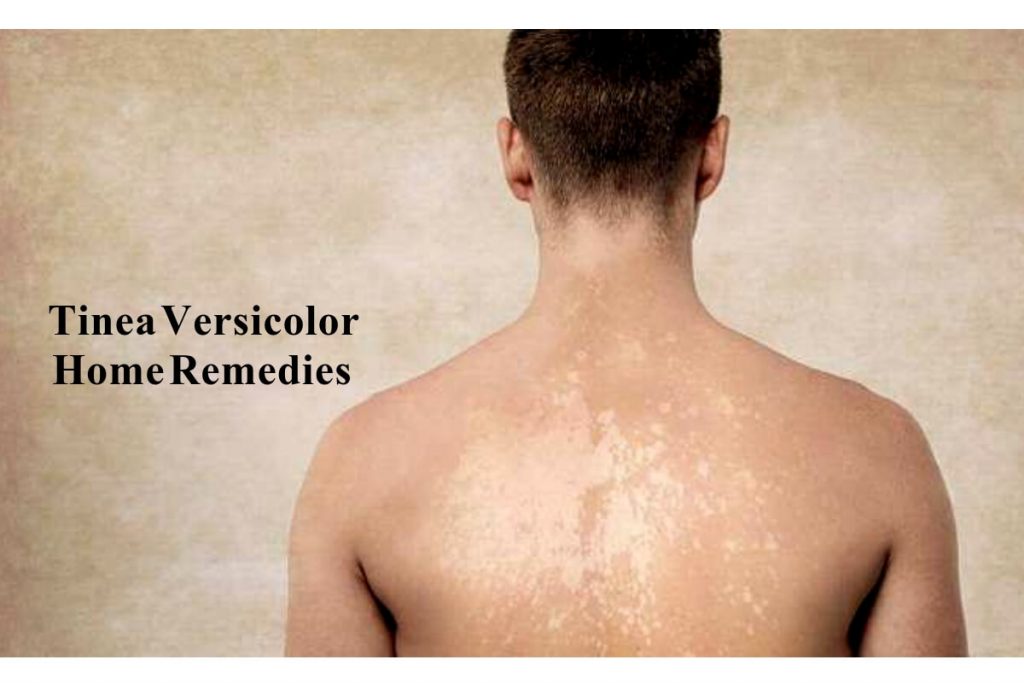 tinea versicolor _ Ayurvedum - Ayurvedum