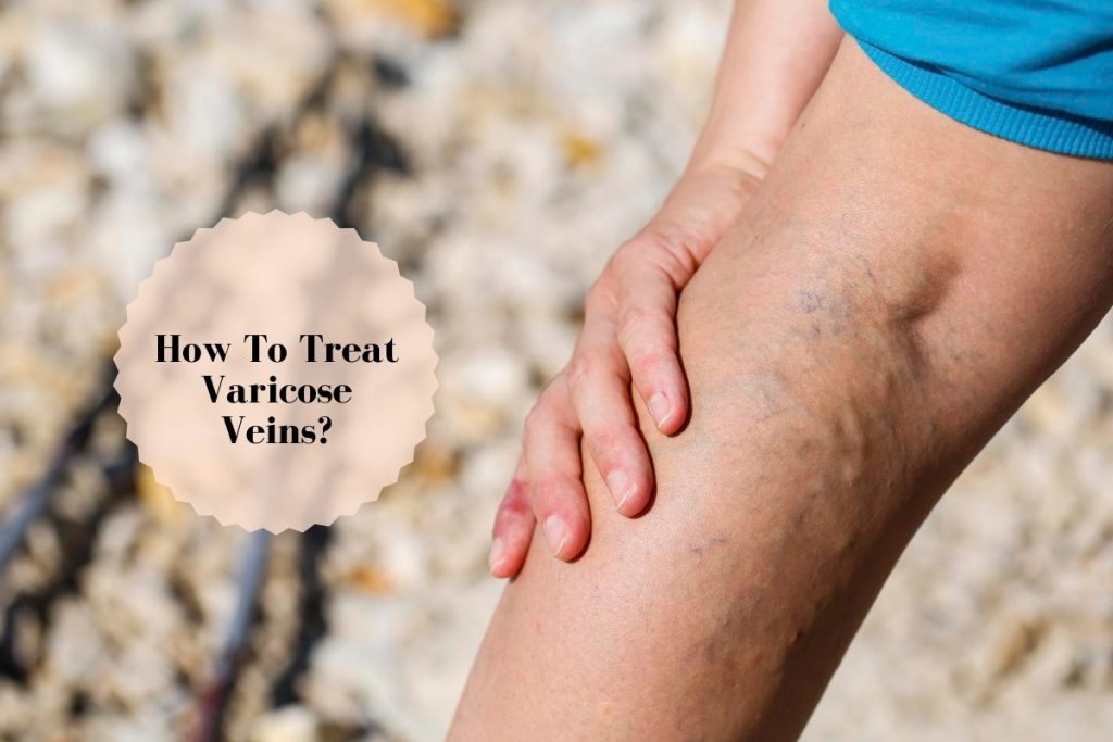 Varicose veins _ Ayurvedum